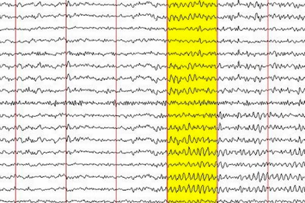 Eeg Neurofeedback As An Evidence Based Treatment Neurocare Group 